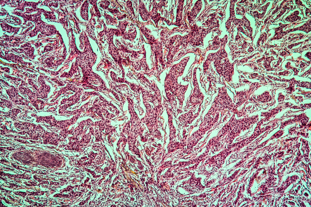 Mammary Carcinoma